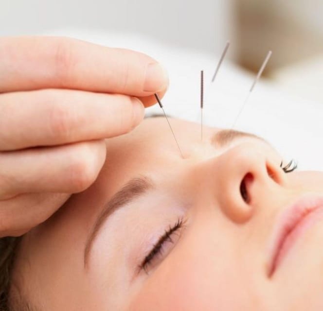 Acupuncture for Relaxation and Wellness - Pricing and Reservation Options